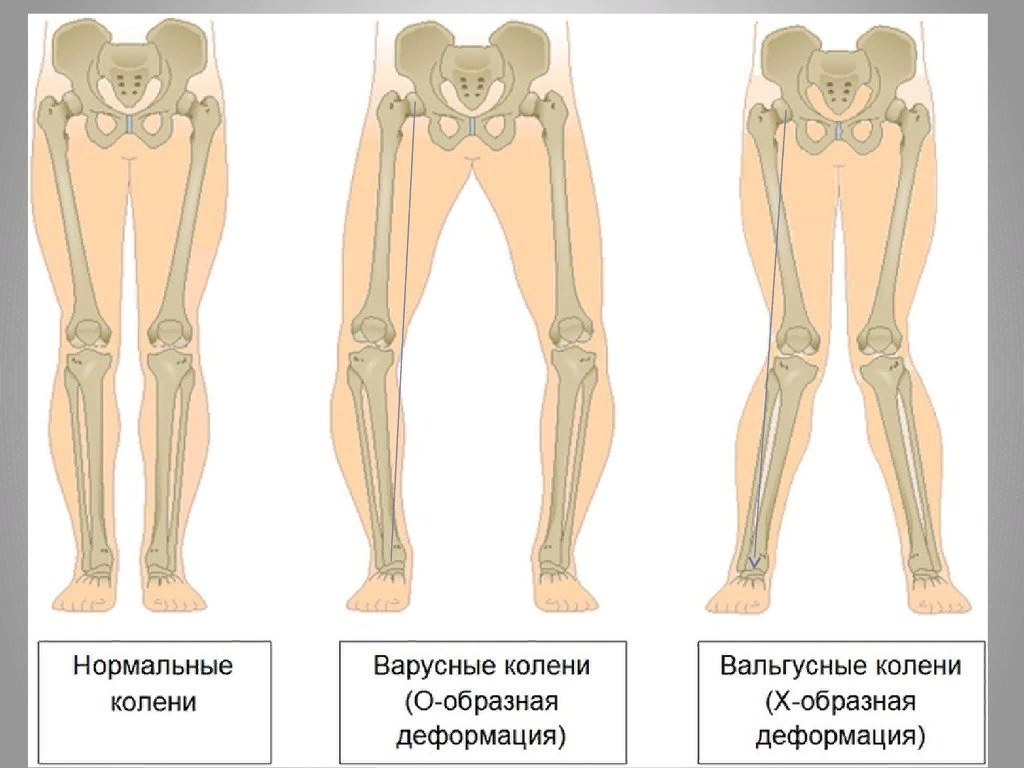 Вальгусная деформация у детей причины. Вальгусная и варусная деформация ног. Варусная и вальгусная деформация коленного сустава. Вальгусная и варусная деформация голени. Вальгус Варус нижней конечности.