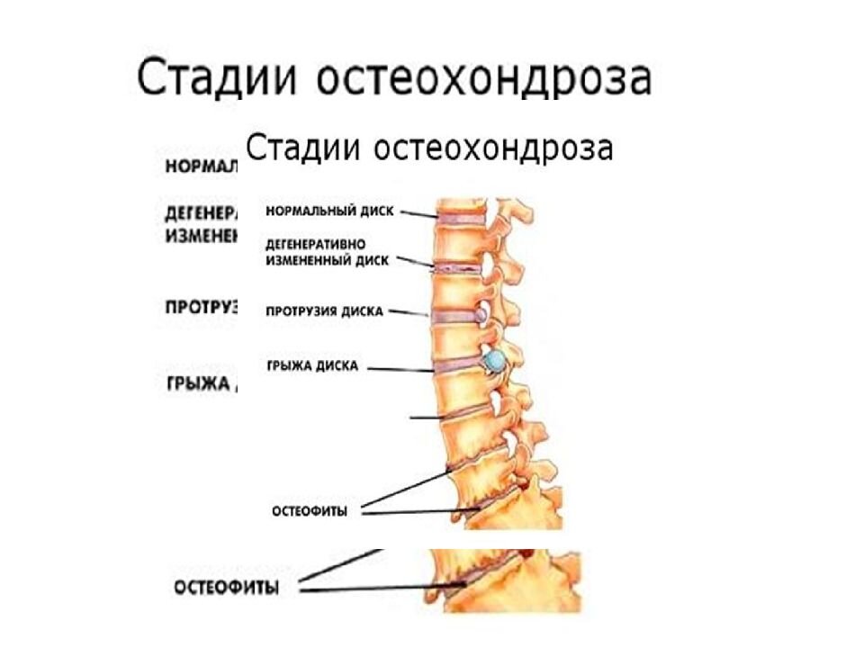 «Шейный остеохондроз» — дегенеративные изменения шейного отдела позвоночника