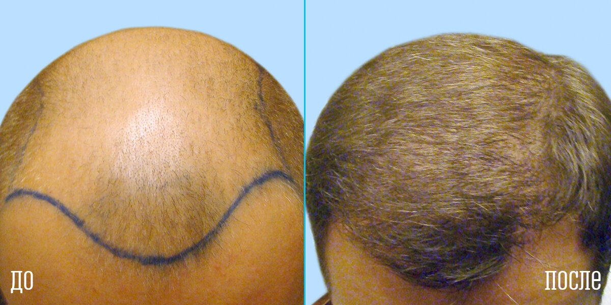 Форум после пересадки. Пересадка волос до и после. Брилев пересадил волосы.