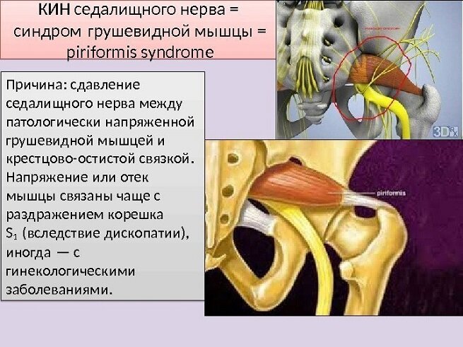 Массаж при защемлении седалищного нерва, Массаж при ишасе