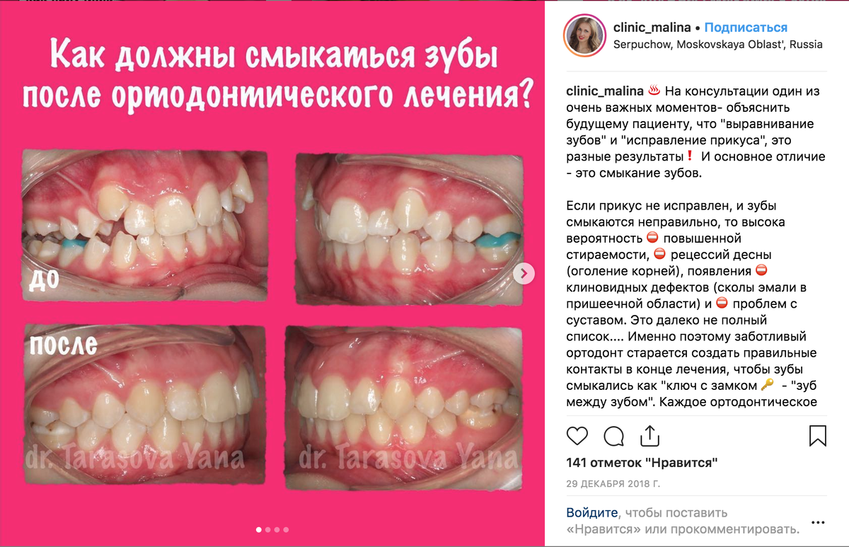 Две верхние фотографии сделаны до лечения. На них — неровные зубы и неправильный прикус. Ниже снимки после ношения брекетов