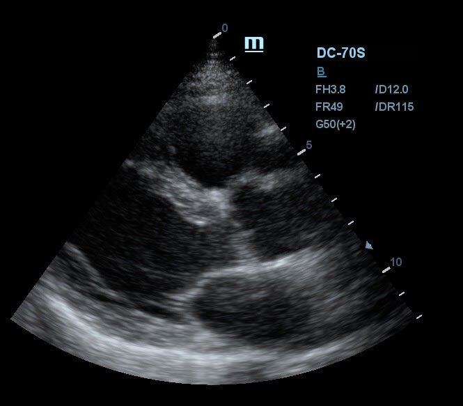 Снимок УЗИ аппарата Mindray DC-70s без использования технологии iClear