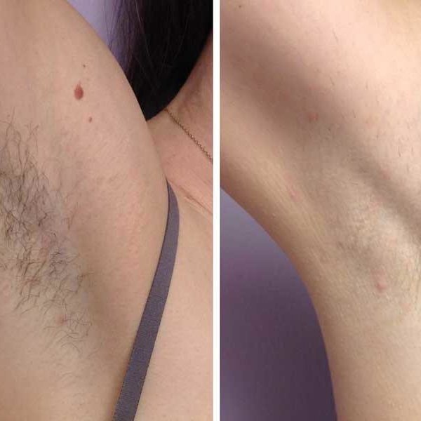 Неделя после шугаринга, неделя после эпилятора, я думаю вы сами все видите.