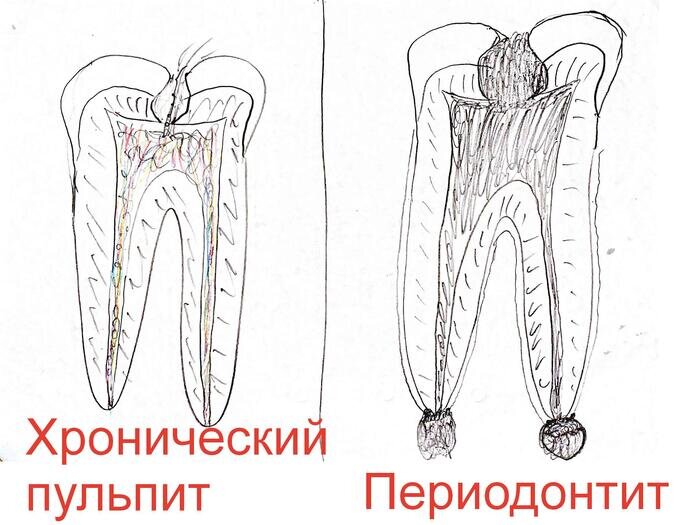 Болит зуб – что делать и как быстро избавиться от зубной боли?