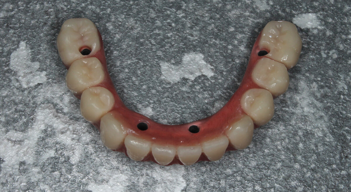 Протез нижней челюсти - временный.