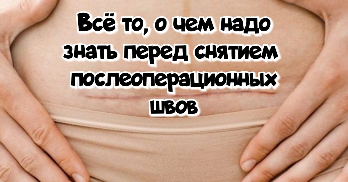 Как снять швы? - YouTube