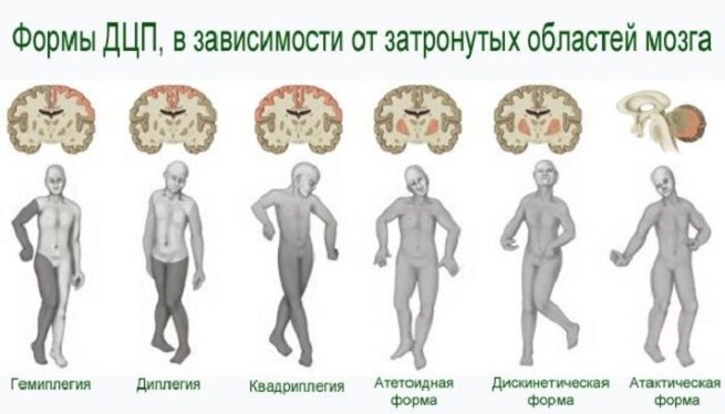 Классификация ДЦП в России разработана неврологом Смирновой К.А, поэтому в современной литературе может встречаться такое понятие, как классификация по Смирновой. Формы ДЦП и их характеристики зависят от участка мозга, который пострадал во время вынашивания или родов.
