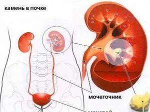 Микролитиаз почек – причины