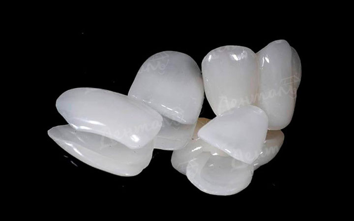 Красивые виниры, которые идеально смотрятся после установки