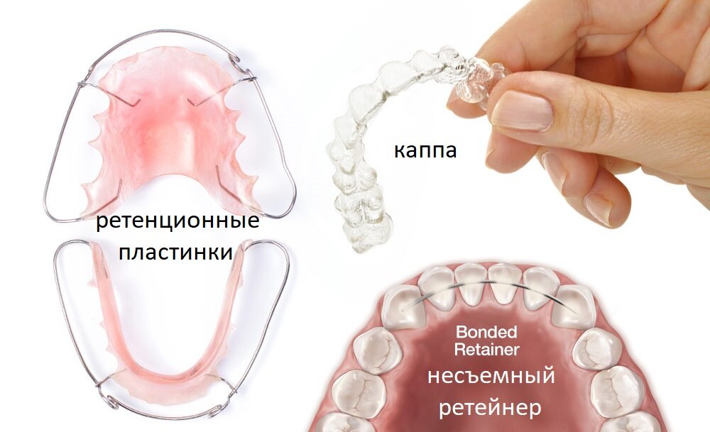 Как выглядит ретейнер после брекетов на зубах РЕТЕНЦИОННАЯ ПЛАСТИНКА Proxima Clinic I Ортодонтия и стоматология I СПб Дзен