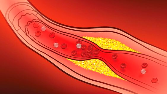 Как убрать холестериновые бляшки на сосудах