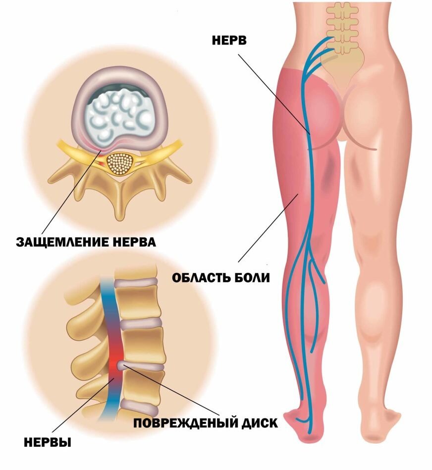 Невралгия пояснично крестцового