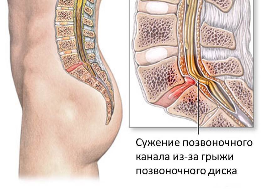 Спинальный стеноз поясничного отдела позвоночника. Абсолютный стеноз позвоночника l5 s1. Стеноз позвоночного канала с4 с5.