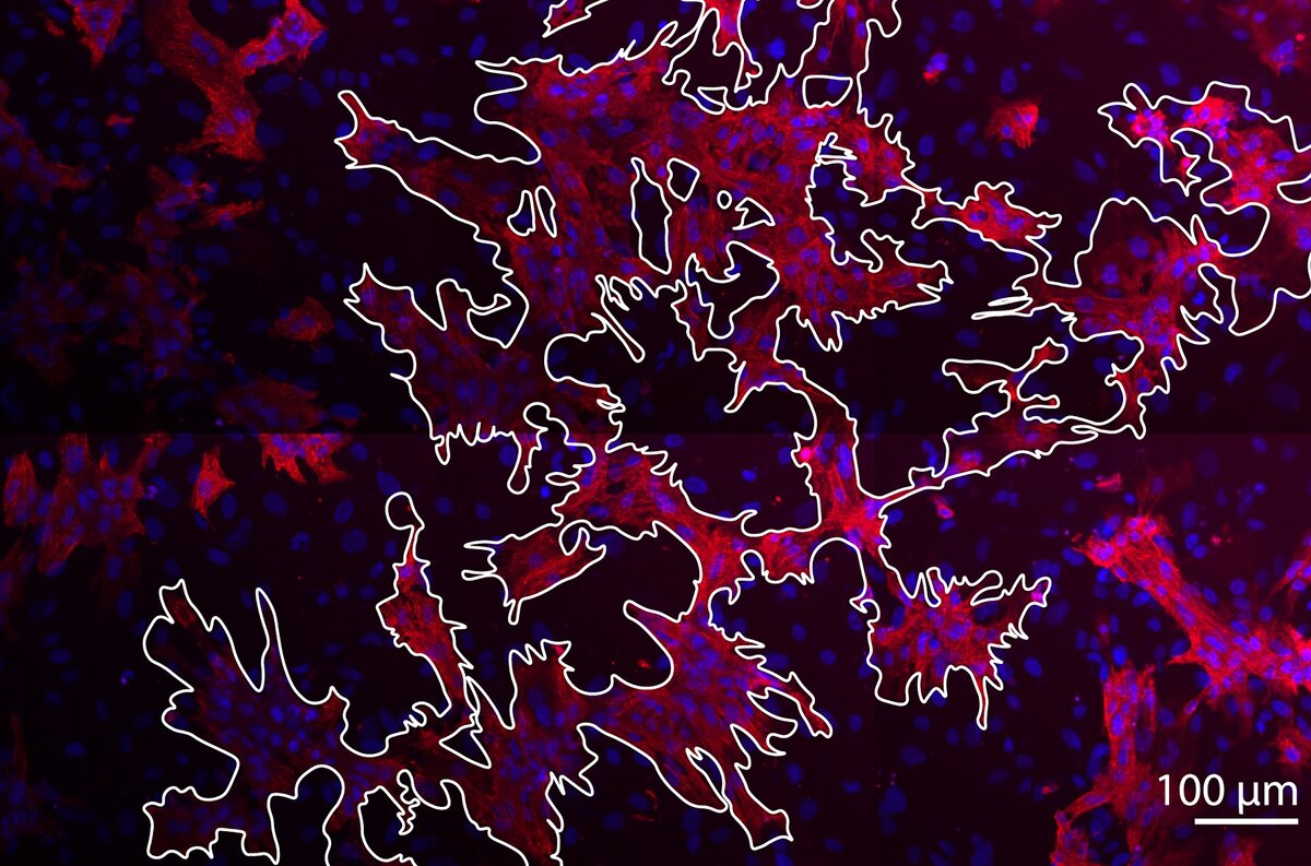 На фотографии, сделанной с помощью конфокального микроскопа, белым контуром выделен проводящий путь из кардиомиоцитов в монослое сердечной ткани (31% кардиомиоцитов и 69% непроводящих клеток). Кардиомиоциты помечены розовым цветом, ядра – синим. Фото стало обложкой журнала PLOS Computational Biology