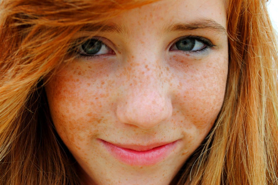 Веснушки. 