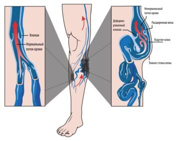 Современные методы лечения варикозного расширения вен ног