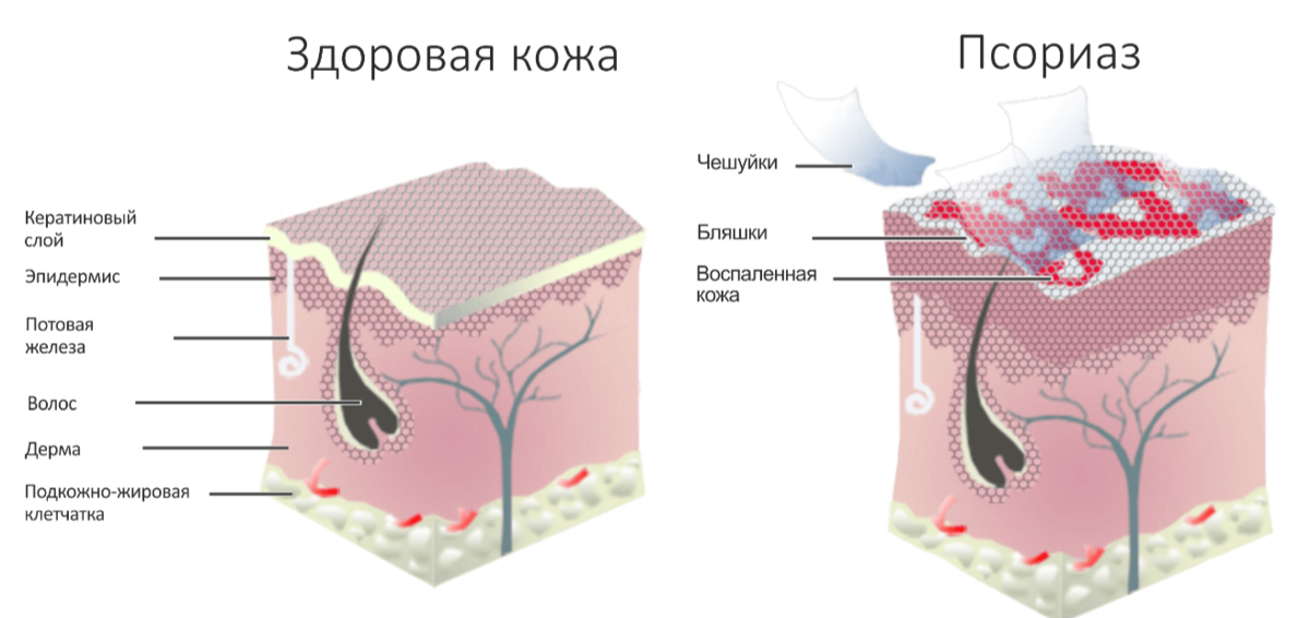 Проявление псориаза