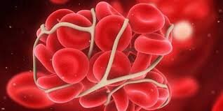 Тромб-это скопление клеток , увязших в сети из белка тромбина.