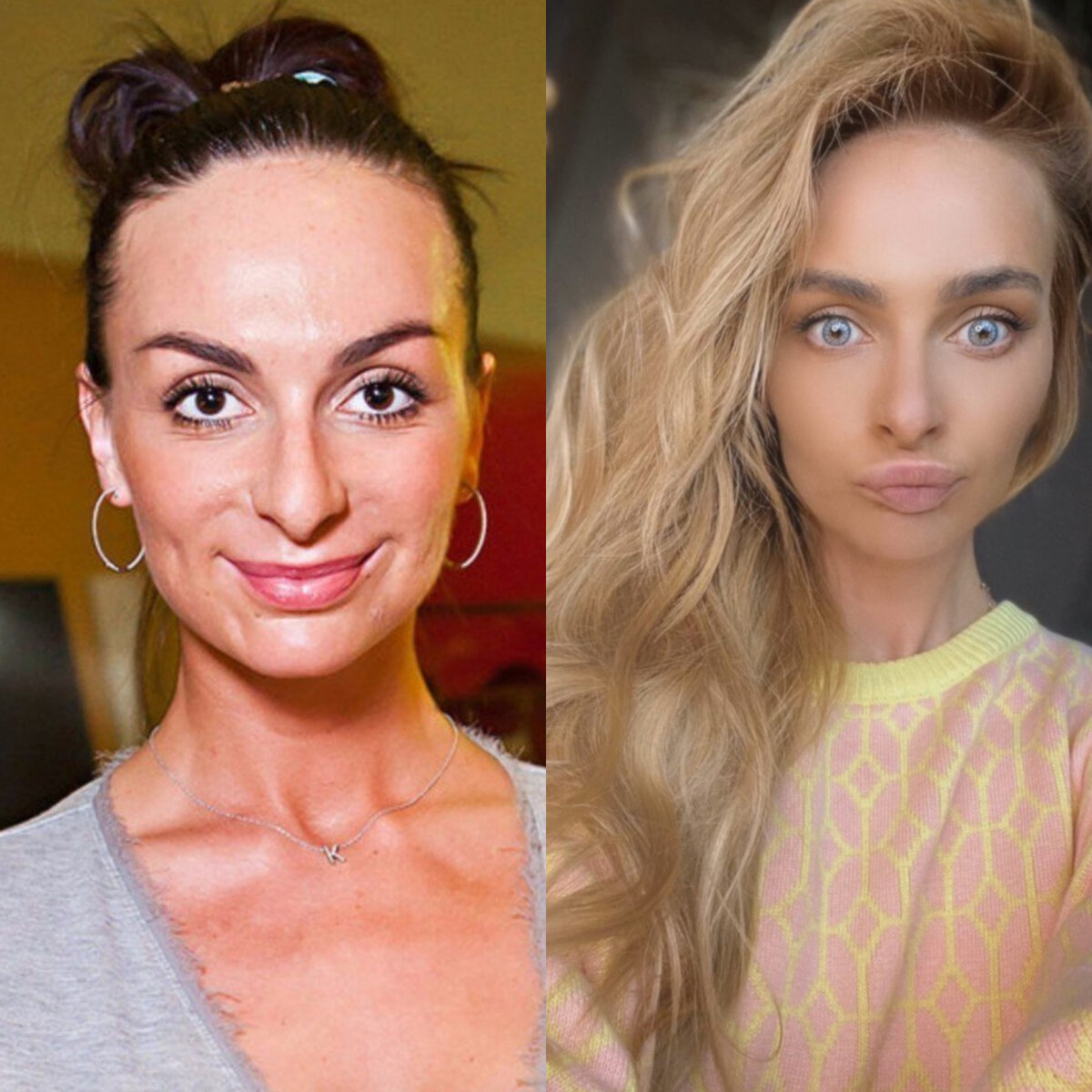 асти операция до и после фото
