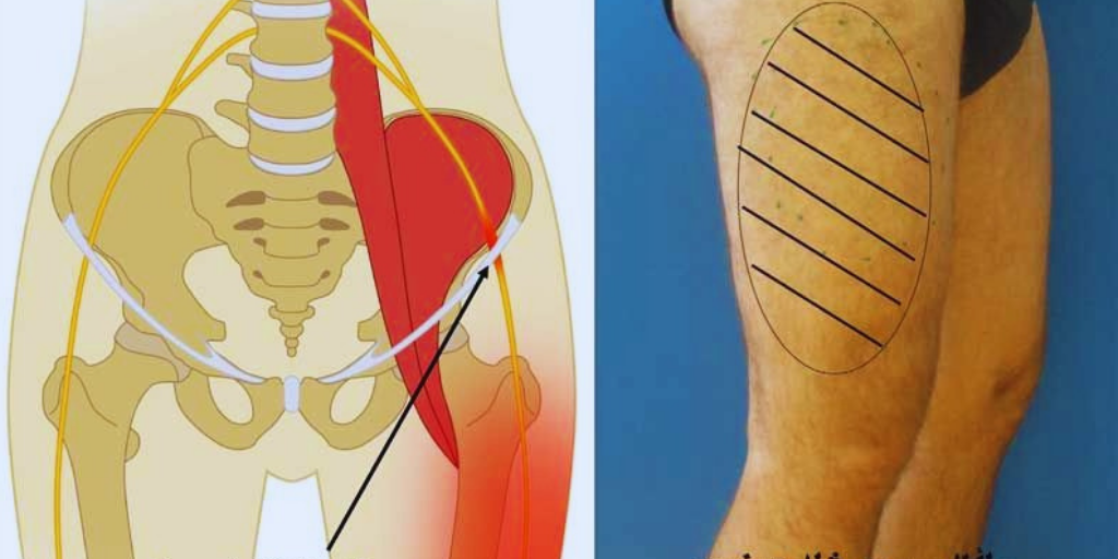 Сдавление латерального кожного нерва бедра.
