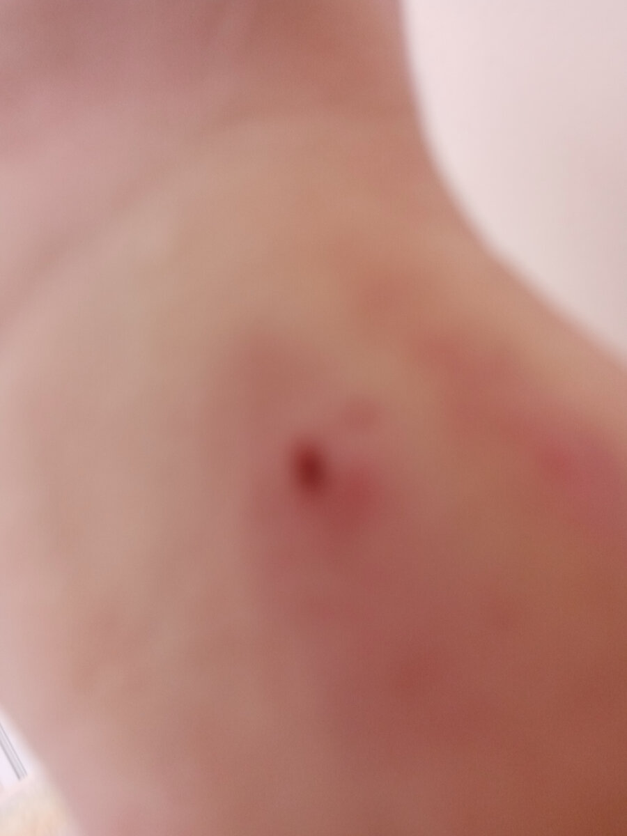 Место установки катетера после снятия повязки 