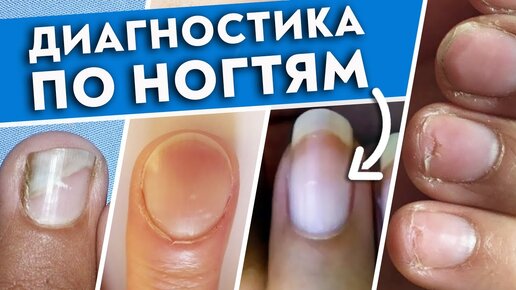 Как определить болезнь по ногтям? Ногти скажут всё о вашем здоровье!