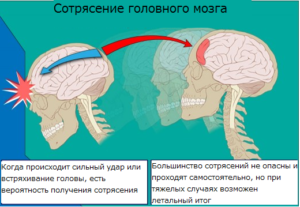 Посткоммоционный синдром