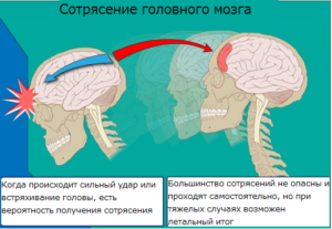 Сотрясение мозга у детей