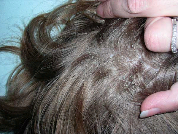 Фотографии заболеваний волос и кожи головы