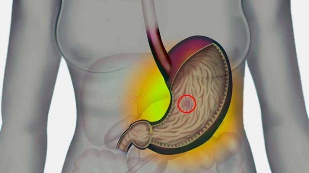 Язва 12 перстной кишки