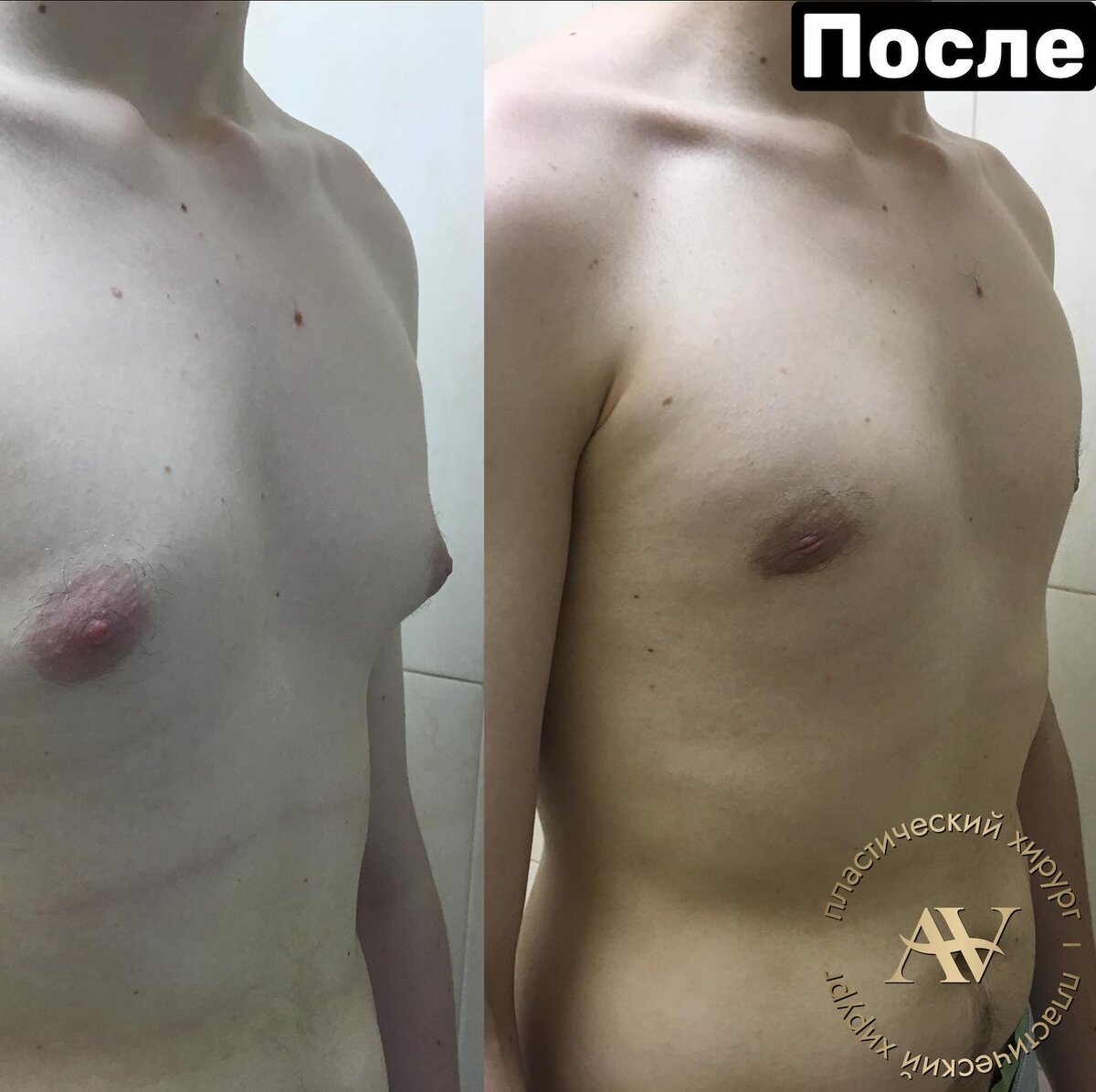 гормоны для мужчин для роста груди фото 4