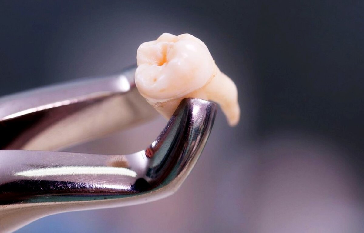 Боль после удаления зуба мудрости: причины и как избавиться?