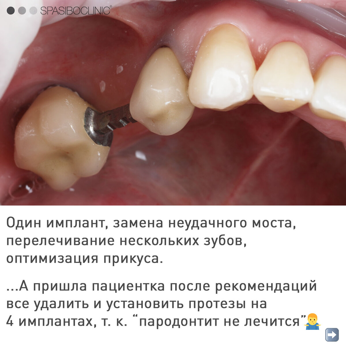 ПАРОДОНТИТ: ВОССТАНОВЛЕНИЕ | Спасибо.Клиник | Дзен