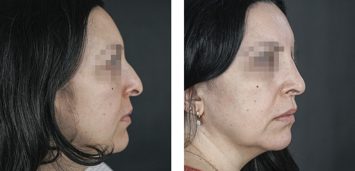 Итоговый результат риносептопластики. 