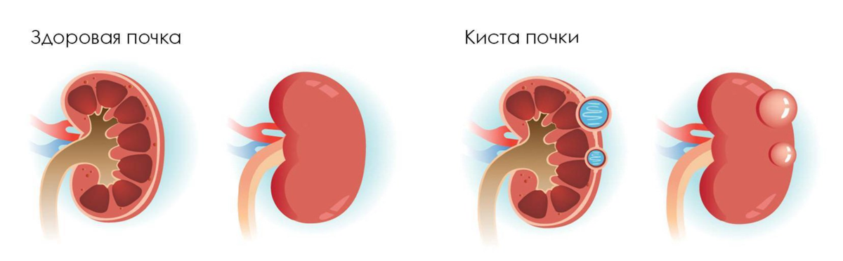 Атеросклероз почечной артерии и почка Гольдблатта | ГБУ РО «КДЦ «Здоровье» в г. Ростове-на-Дону