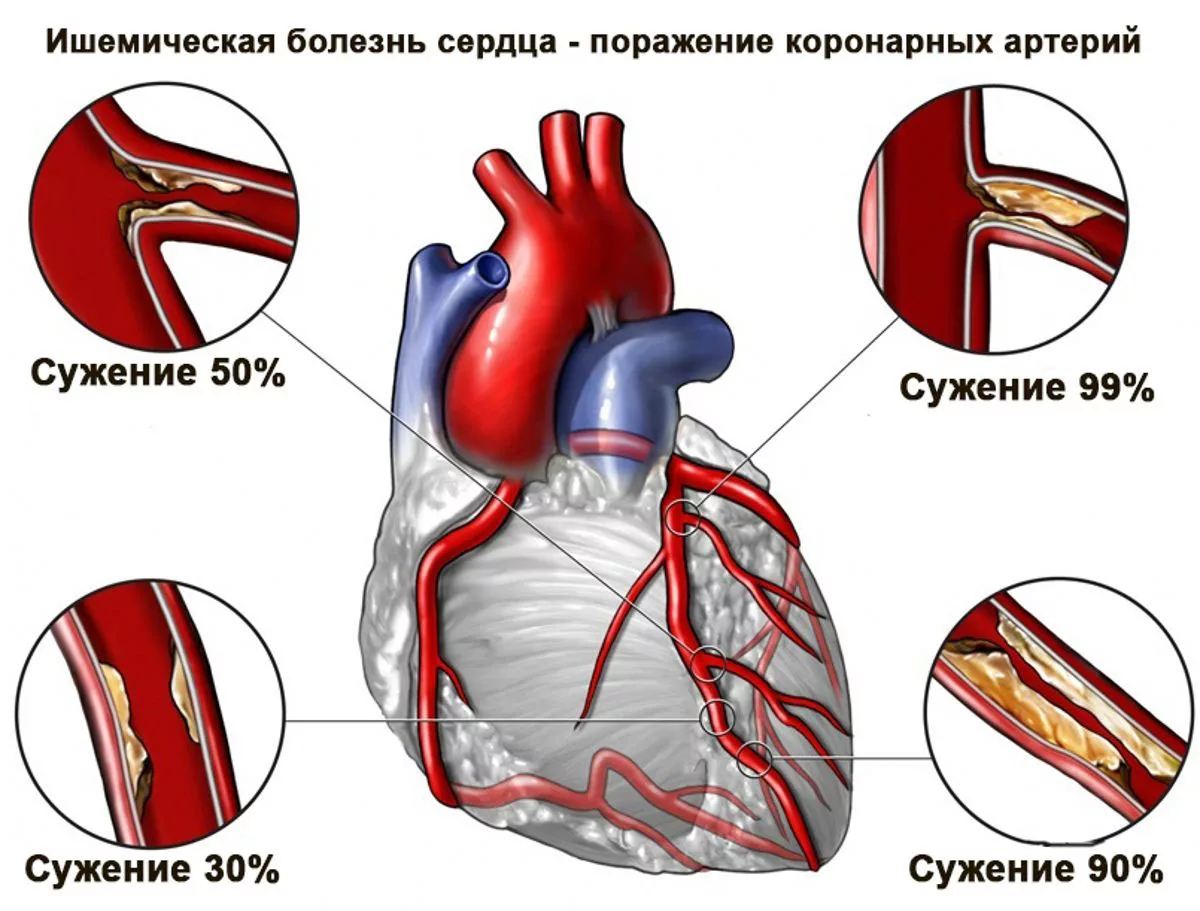 Чем опасна ишемия. Ишемическая болезнь сердца (ИБС). Ишемическая болезнь сердца стенокардия инфаркт миокарда. Ишемическая болезнь сердца поражение миокарда. ИБС стенокардия атеросклероз симптомы.