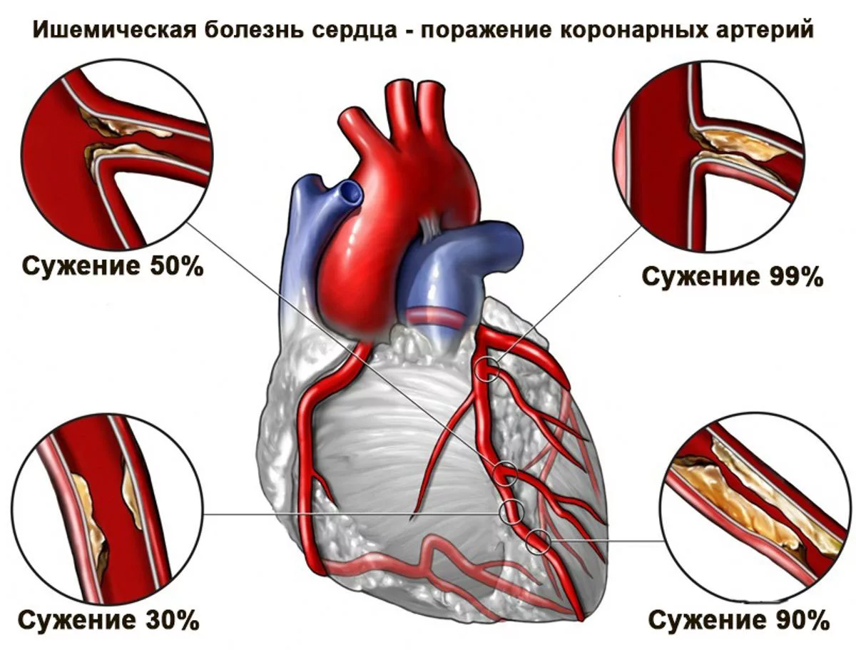 Ишемия т. Ишемическая болезнь сердца (ИБС). Ишемическая болезнь сердца стенокардия инфаркт миокарда. Ишемическая болезнь сердца поражение миокарда. ИБС стенокардия атеросклероз симптомы.