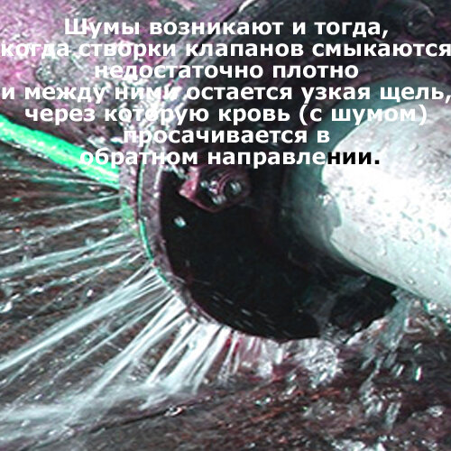 шумы при недостаточности