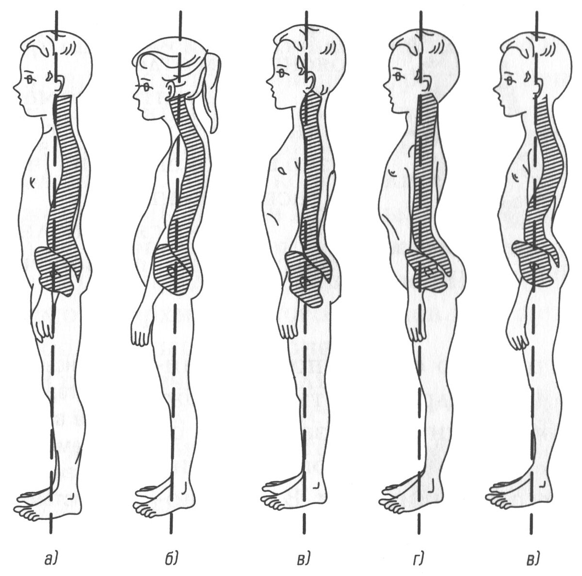 Рассмотрите рисунки 1 3 с изображением изменений осанки человека как называется нарушение осанки 3