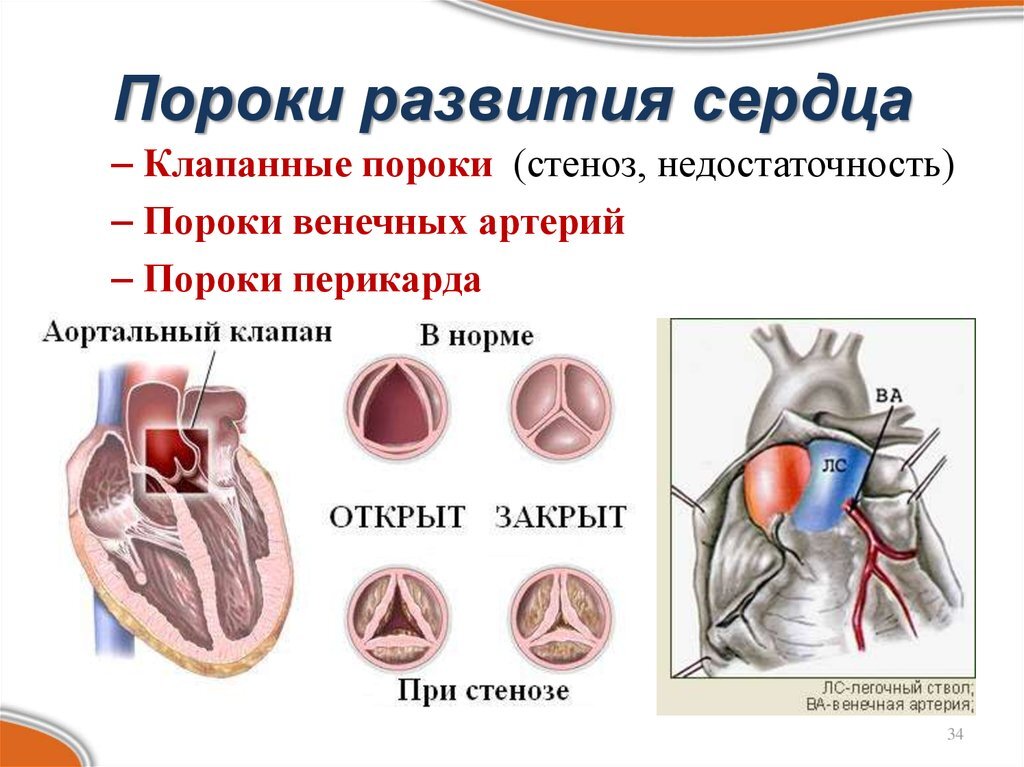 Клиническая картина приобретенных пороков сердца