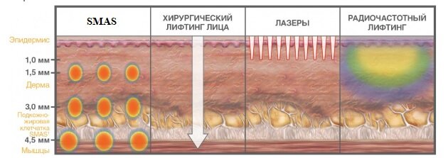 Сравнение смас-лифтинга с другими аппаратными процедурами.