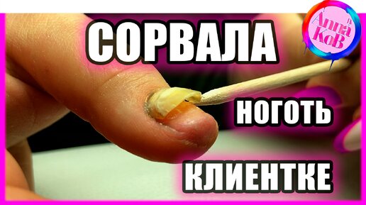 УДАЛЕНИЯ ногтя 😱😱 | Дизайн ногтей 2023 #маникюр #новогоднийдизайн #nailart