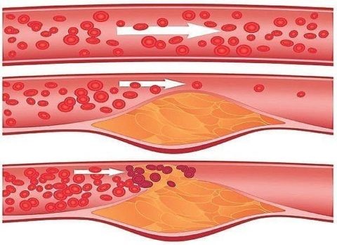  Своевременная чистка сосудов поможет избежать атеросклероза