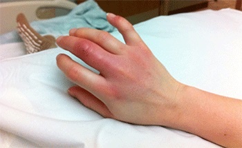  Воспаление раны