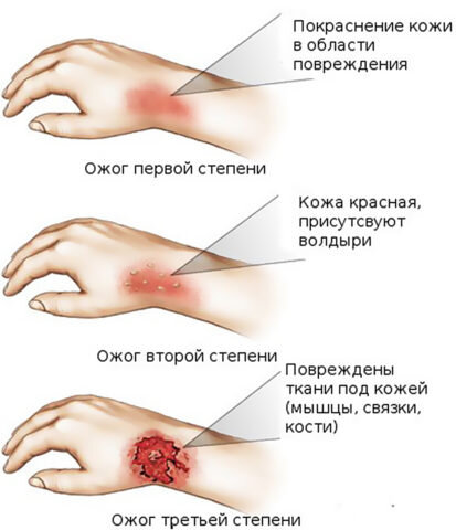  Степени ожога