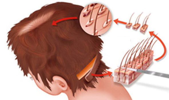 Пересадка волос методом FUT