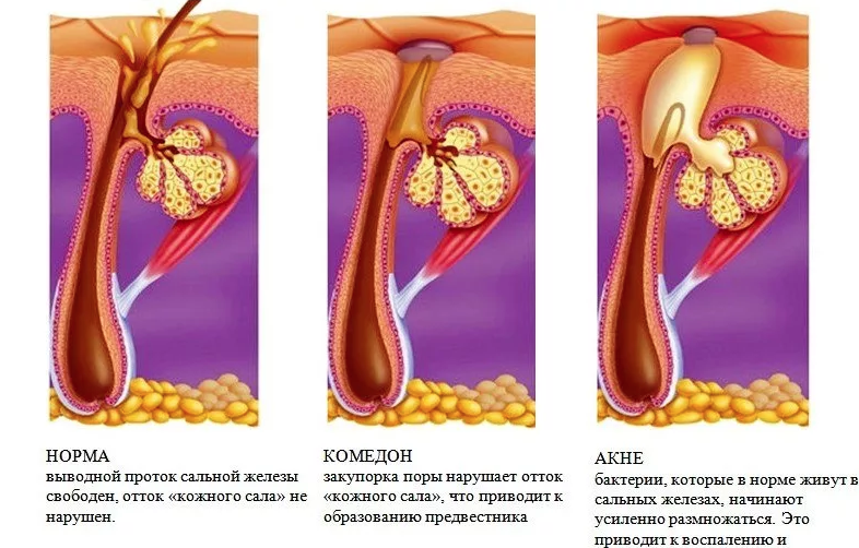 Закупорка фолликулов. Воспаление сальных желез. Закупоривание сальных желёз. Воспаленная сальная железа.