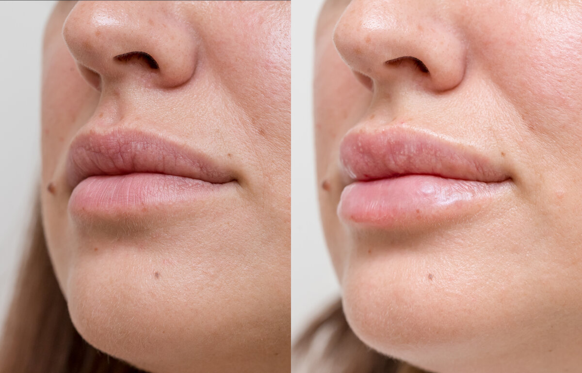 Фото ДО и ПОСЛЕ процедуры.