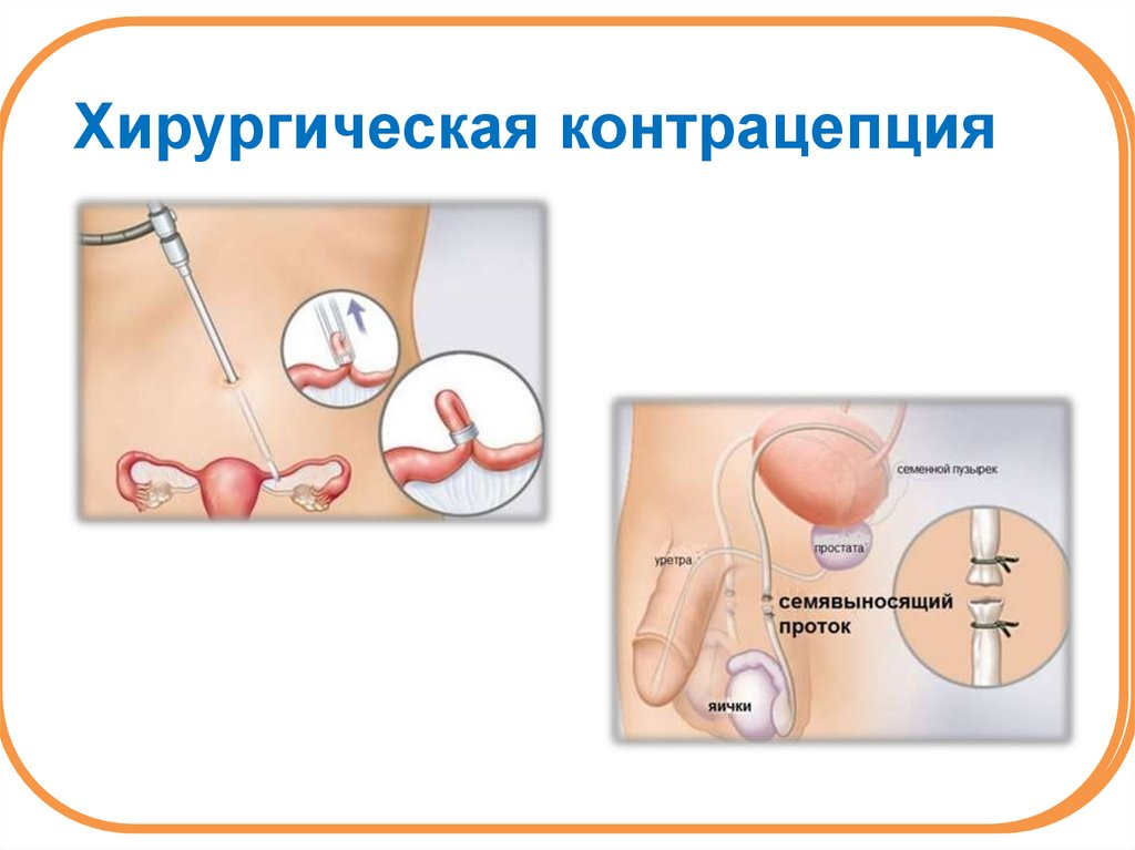 Перевязка маточных труб картинки