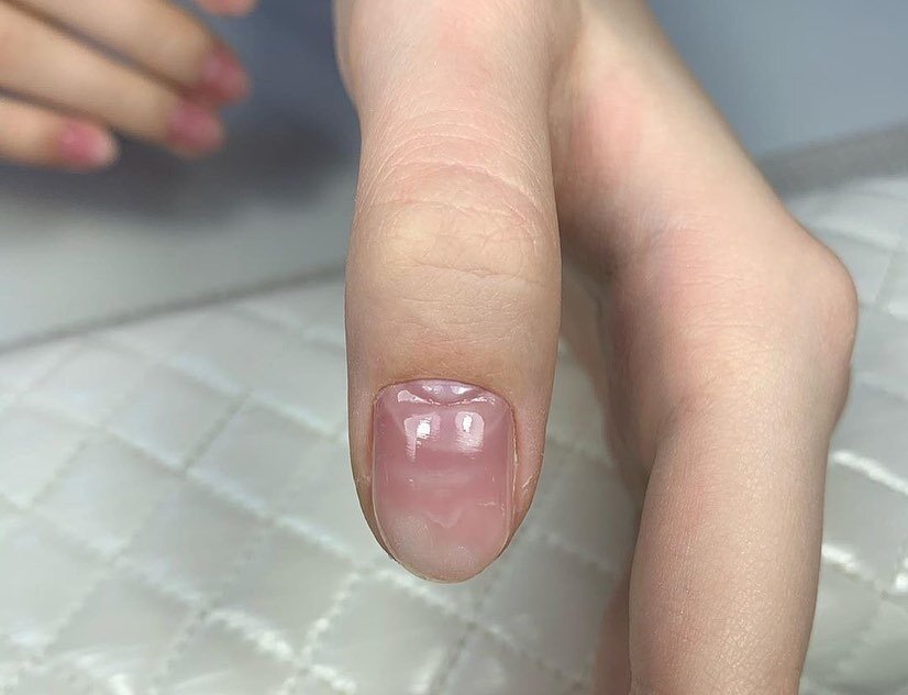 Необратимое повреждение матрикса. Фото - @julia_soms.